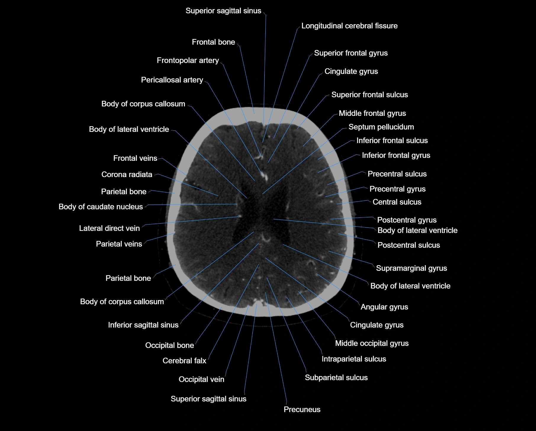 CT scan brain axial labelled cross sectional anatomy image-img-000047.webp